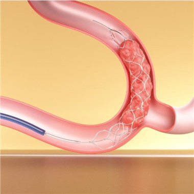Stent Retriever Thrombectomy Devices