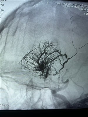 First Case Of Hypervascular Tumor Reported in India